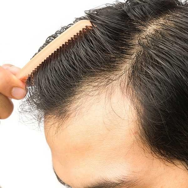 No Scars, No Stitches, 25 Yr Warranty on Hair Transplant