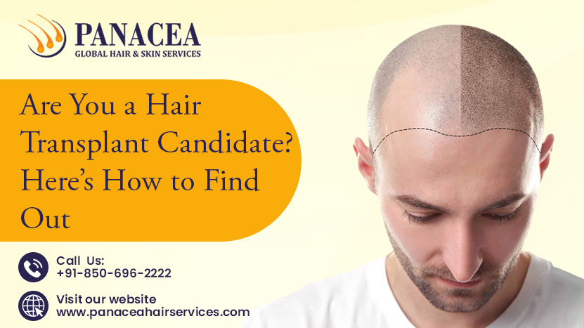 Are You a Hair Transplant Candidate Here is How to Find Out