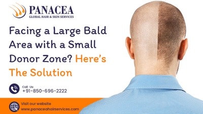 Facing a Large Bald Area with a Small Donor Zone Here the Solution