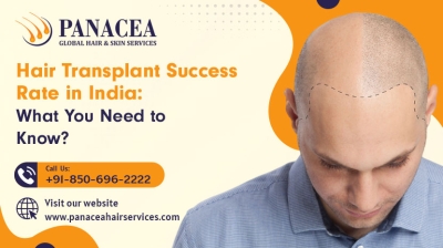Hair Transplant Success Rate in India What You Need to Know
