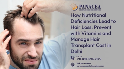 Prevent with Vitamins and Manage Hair Transplant Cost in Delhi