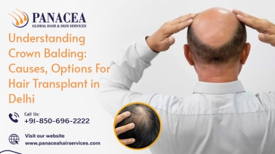 Understanding Crown Balding Causes Options for Hair Transplant in Delhi