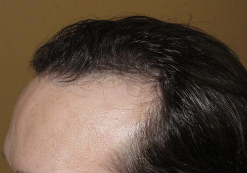 Hair Transplant Repairs-Before & After Results