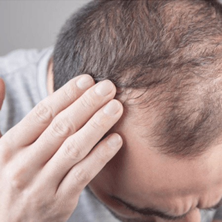 BIO FUE Hair Transplant Cost in Delhi-NCR